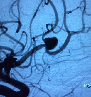 Aneurysm pre-clipping