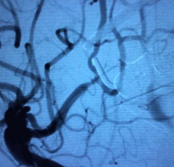 Aneurysm post-clipping
